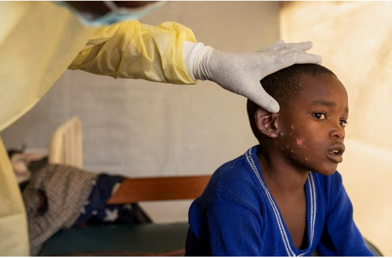 2 (02.00 uur)UK prepares for mpox cases after global emergency declared